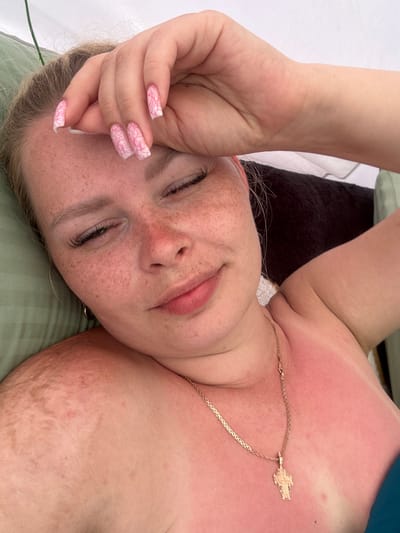 A close-up, overhead shot shows a young woman lying down, with her right hand on her forehead. She has light skin with freckles and her eyes are closed. Her body, visible from the chest up, is red from sunburn, with a lighter pattern on her left shoulder. She is wearing a gold chain with a cross pendant. The background is out of focus, with a pillow on the left and a dark fabric behind her. The image appears to have been taken outdoors in a sunny location.