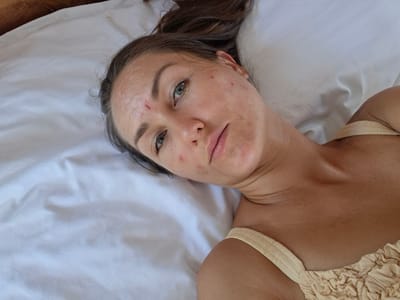 The image shows a woman lying on a white bed sheet. She is wearing a light yellow top with thin straps. Her face is visible, and she has blemishes on her skin. The background is out of focus. The location in Lodtunduh, Indonesia is not discernible from the image.