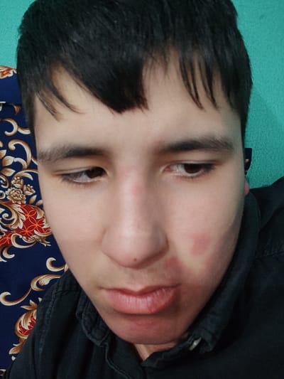 A close-up, low-angle portrait features a young individual, likely male, with short dark hair and a light complexion, looking downward. The subject wears a dark, possibly denim, collared shirt, unbuttoned at the top. A prominent reddish, roughly circular mark is visible on the subject's left cheek (viewer's right), accompanied by a smaller, fainter reddish mark below it. The bridge of the nose also exhibits slight redness. A small, dark object, consistent with an earbud, is partially visible behind the subject's right ear (viewer's left). The background is divided: to the viewer's left is a dark blue fabric with an ornate gold, red, and cream floral pattern, while to the viewer's right is a solid teal surface. This indoor setting provides no specific visual cues to identify a precise location within Rishtan, Uzbekistan.