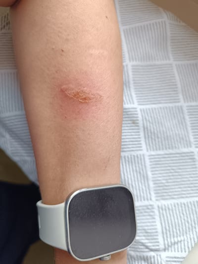 The image shows a close-up view of a person's arm with a burn or abrasion on the skin. The affected area is reddish and appears to have some dead skin or scab. A white smartwatch is visible on the wrist below the injury. The background consists of a patterned fabric, possibly a bedsheet or blanket. The image is a still photograph and does not provide information about a specific location in Olsztyn, Poland.