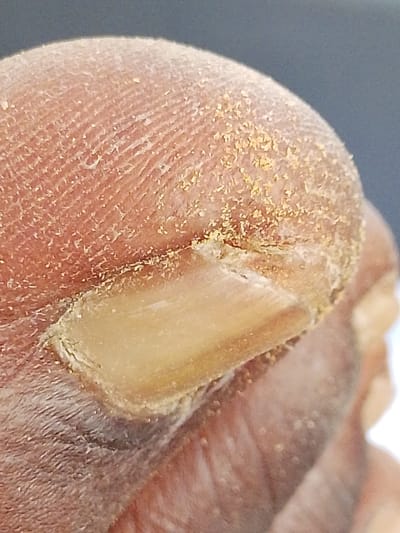 A close-up shows the tip of a dark-skinned toe, likely the big toe. The skin appears dry and peeling, with small, yellowish flakes scattered across the surface. The nail is thick and discolored, appearing yellowish-brown. The cuticle area appears dry and slightly raised. The overall image suggests a potential fungal infection or severe dryness affecting both the skin and nail.