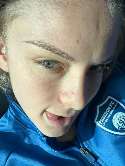 A close-up portrait depicts a fair-skinned female with light-colored hair and eyebrows. Her left eye is green/hazel, and her right eye is partially obscured by shadow. Small red blemishes are present on her forehead and nasal area. Her mouth is slightly open, revealing the tip of her tongue. The female wears a bright blue athletic jacket with a silver zipper, partially undone, bearing an "UMBRO" brand mark on the zipper pull. On the jacket's right chest area, a blue and white crest is visible, displaying "FREEDOM F.C." and the motto "Libertas fulvo pretioso ouro". Strong, directional lighting illuminates the scene, casting pronounced shadows across her face and clothing. The subject is associated with Freedom F.C., a football club based in Borgo San Dalmazzo, Italy, establishing the context for the location.