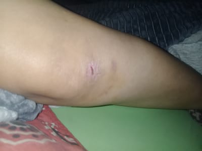 The image shows a close-up of a person's knee. There appears to be a healing wound or scar on the knee. The background includes bedding with different textures and colors. The specific location within Villa Ballester Noroeste, Argentina, cannot be determined from the image.