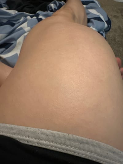 The image shows a close-up of a person's upper thigh and part of their torso, with a portion of dark-colored clothing visible at the bottom. The person is lying on a bed with blue and white patterned bedding. The skin appears to have some very faint, light-colored marks or textures. The lighting is dim and casts soft shadows. The image is cropped in a way that obscures the face and any distinct identifying features of the person. There is no indication of the location being Vancouver, United States of America.