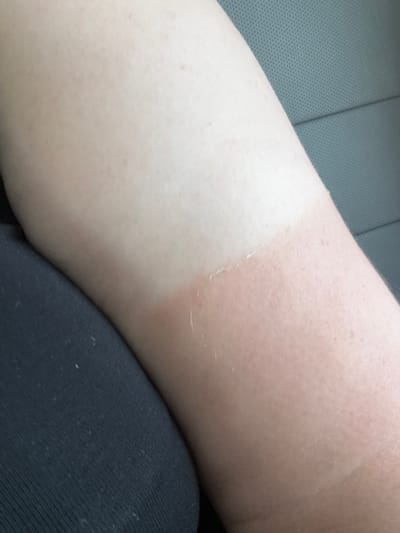 This is a close-up, eye-level medium shot of a person's arm, showing a distinct tan line and some peeling skin, indicative of a recent sunburn. The arm is positioned across a textured gray surface, likely the seat of a vehicle, and partially overlaps with dark fabric, possibly clothing. The lighting suggests an indoor setting, possibly a car interior, with natural light from a window illuminating the arm. There is no visible text or discernible time of day or weather conditions. The overall impression is one of personal experience with sun exposure. The provided location context "Мастоцкі сельскі Савет, Belarus" does not offer any direct visual cues within the image itself.