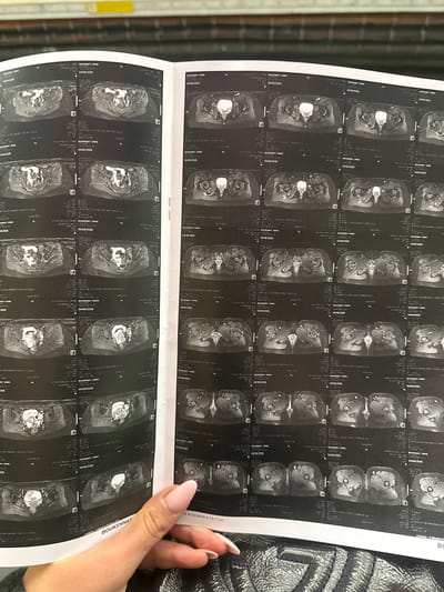 A person's hand, adorned with manicured nails painted in a light pink/nude shade, is shown holding open a medical imaging report. The report displays multiple grayscale MRI scan images arranged in a grid format across two pages. These images appear to be axial slices of an anatomical region, likely the pelvis, hip, or lower abdomen, showing bones and soft tissues.
Repeatedly visible text on the report includes the name "BOUKENNAT, SIRINE" and the date "04/06/2026". On the upper right page, partially obscured by the hand, the text "né le 04/06/26 à 10:17:31" is visible, which translates to "born on 04/06/26 at 10:17:31". Other smaller text like "F", "AL", and "Licence: 21 Medical" can also be seen. The background consists of a dark, textured surface, possibly a bag or jacket, and a blurred, dark vertical pattern on the left, suggesting an indoor setting. The activity depicts someone reviewing or presenting these medical scans.