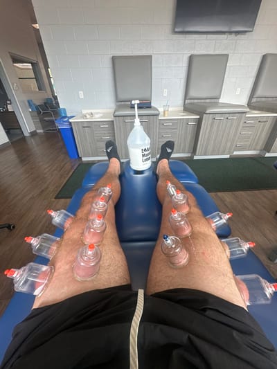 In a physical therapy or wellness clinic located in Miromar Lakes, United States, a first-person perspective image depicts a patient lying supine on a blue padded examination table. The patient's bare legs, extending into the foreground, are undergoing cupping therapy. Ten clear plastic cupping cups with orange plunger tops are affixed to the upper and lower aspects of the left leg, while seven similar cups, one with a blue plunger top, are applied to the right leg, showing areas of suctioned skin. The patient is wearing black athletic shorts and black socks. A large white pump bottle, labeled "Massage Lotion," rests on the patient's abdomen between their legs. In the background, a light grey cinder block wall features three identical treatment stations, each with a grey cushioned examination bench and a light wood-grain cabinet with silver handles. A black wall-mounted television is visible above the rightmost station. To the left, a blue cylindrical trash can sits near an open doorway leading to another room with wooden flooring and additional seating. A light brown disposable coffee cup is placed on one of the cabinets. The floor in the treatment area is covered with a dark green mat.