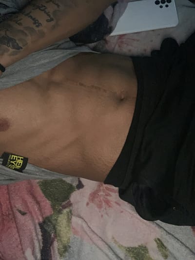 A person is lying down on a bed with a floral patterned bedspread. The person is wearing a black top and grey pants. The person has a scar down the center of their abdomen and a tattoo on their left arm. A white smartphone is visible on the left side of the image. A tag that reads "HEN EYS PROJECT" is visible on the person's grey pants. The location is not discernible from the image.