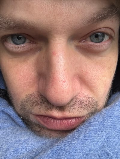 This is an extreme close-up, frontal portrait of an adult Caucasian male's face, taken in Longone al Segrino, Italy. The image focuses on the area from just above the eyebrows to the upper lip, with the lower portion of the face obscured by clothing.

**People:** One individual is depicted.
**Subjects/Objects:** The subject has light blue eyes with visible pupils and subtle redness on the lower eyelids. Light brown eyebrows are partially visible above each eye. The skin is fair with visible pores, particularly on the nose and cheeks. A small red mark or blemish is present on the bridge of the nose between the eyes, and other smaller reddish spots are visible on the nose and cheeks. Stubble or short facial hair covers the upper lip, chin, and cheeks. The lips are closed, appearing full and pinkish, with defined vertical lines. A light blue, textured fabric, consistent with a sweater, hoodie, or scarf, wraps closely around the lower face, covering the jawline and extending upwards towards the lower cheeks, partially obscuring the lower face.
**Actions/Interactions:** The individual is looking directly into the camera, resulting in a direct gaze.
**Environment:** The background is entirely out of frame due to the extreme close-up, providing no environmental context beyond the subject and their clothing.