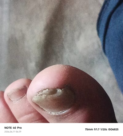 This is a close-up, indoor photograph of a person's toes, focusing on a damaged toenail. The background appears to be a textured fabric, possibly a bedsheet or blanket, in shades of gray and blue. The skin of the toes is pink, with visible texture. The damaged toenail is discolored and appears to be peeling or thickened, with a whitish-yellow hue. There are also other toes visible in the frame, some appearing to have intact nails and others with less distinct features due to the close-up perspective and focus. Text overlays in the bottom left and bottom right corners of the image provide metadata. The bottom left text reads "NOTE 40 Pro" and "2026.06.17 06:29". The bottom right text reads "75mm f/1.7 1/20s ISO6825". The image does not contain any elements that would suggest a location in the city of Sergeli, Uzbekistan.