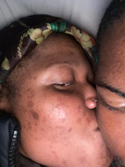 The image shows a close-up, intimate shot of two people sharing a kiss. One person, wearing a satin bonnet with a floral pattern, is positioned on the left, with their eyes closed and skin showing visible blemishes and some hyperpigmentation. The other person's face is partially visible on the right, with their lips touching the other's. The scene appears to be indoors, possibly in a bed, given the soft lighting and white background that could be bedding. The overall impression is one of personal connection and affection. The image does not contain enough visual information to determine its location in Randburg, South Africa.