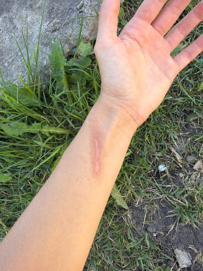 The image shows a close-up view of a person's forearm and hand resting on the ground in an outdoor environment with grass and some rocks. The forearm exhibits a scar on the wrist area. The hand is open, palm facing upwards. The background consists of green grass, dirt, and a portion of a gray, rough surface, possibly concrete. There is no indication of the location being the city of Петряксы, Russia, nor any specific action or interaction occurring.