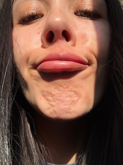 A close-up, overhead shot depicts a person's face, likely female, with dark hair framing the sides. Her eyes are mostly closed, with visible eyelashes. The skin is light-toned, with prominent acne scars on the right cheek. The lips are full and appear slightly pink. Sunlight highlights some areas of the face while casting shadows on others. No indications that this image was taken in Molodezhnyi, Russia, can be determined.