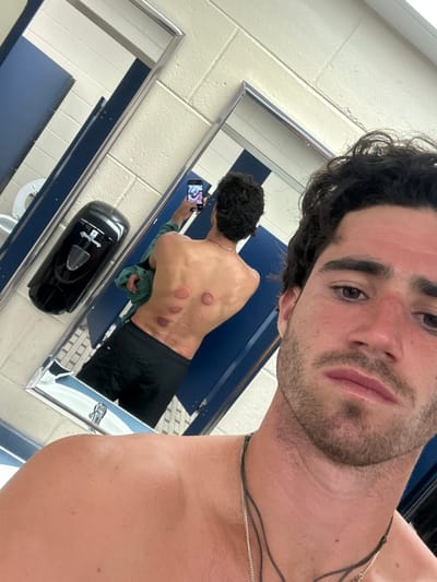 The image depicts a male individual taking a mirror selfie in a public restroom or locker room located in Miromar Lakes, United States. The man, with dark curly hair, stubble, and a reddish complexion on his face and shoulders, wears two necklaces – one a silver chain, the other a dark cord. His bare torso is visible in the foreground. In the reflection of a large framed mirror, his back is shown to have multiple circular, dark red to purplish marks, consistent with cupping therapy, primarily on his upper and mid-back. He is holding a black smartphone with his right hand to capture the image of his reflection. He is wearing dark shorts. The background environment consists of white brick-patterned tiled walls, blue stall doors, a black wall-mounted hand soap dispenser, and part of a white toilet bowl visible in the reflection. The floor has a grid pattern of light and dark tiles.