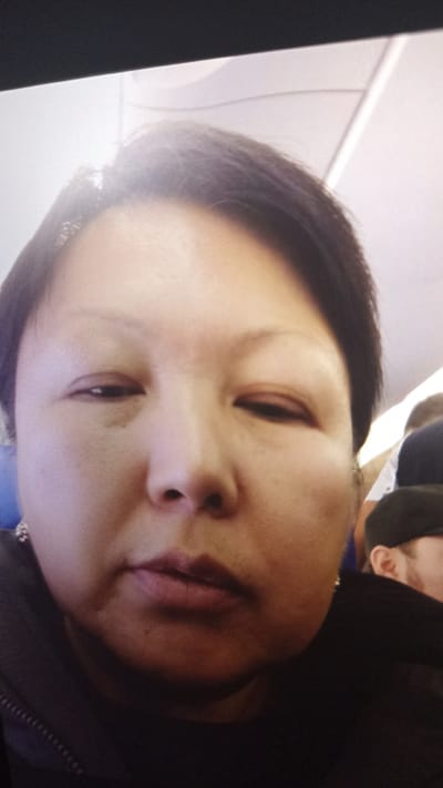 The image is a close-up, selfie-style photograph of an adult East Asian person on an airplane. The person is looking directly at the camera with their mouth slightly open. Their right eye appears swollen, with dark circles underneath. The background is the interior of an airplane cabin, with visible overhead compartments and other passengers in the background. The lighting is soft and diffuse, likely from the cabin lights. There is no indication of the city of Samarkandek, Kyrgyzstan in this image.