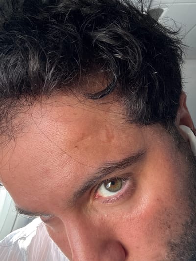 A close-up, portrait-style image focuses on a person's face. The subject has dark, curly hair with some apparent dandruff. The visible eye is hazel with a visible reflection. Skin tone is medium with a light scar near the temple. The image captures an upward angle, partially revealing the nose and a glimpse of an ear with a white object, possibly a cotton swab. Part of a white, striped shirt is also visible in the lower right corner. The environment is indistinct, lacking recognizable features related to the city of Berg, Luxembourg.