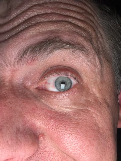 This is a close-up, forensic photograph of a human eye and surrounding facial features. The subject's skin appears to have visible pores and wrinkles, particularly on the forehead and cheek. There is a mole on the side of the nose. The eye itself is a pale blue-grey color, with visible blood vessels in the sclera, suggesting possible irritation or inflammation. The iris is clearly defined, and a reflection is visible in the pupil. The eyebrows are sparse and greyish. The image composition focuses intensely on the eye and facial details, with the background obscured by darkness. The lighting appears to be artificial, casting shadows that highlight the textures of the skin. There are no discernible elements that would provide information about the location being the city of New Britain, United States of America, as the image is solely focused on a human facial detail.