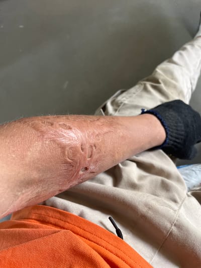 The image shows a close-up of a person's forearm exhibiting significant skin trauma, appearing as severe abrasions and indentations with some redness and possible open wounds. The skin texture is rough and uneven in the affected area. The person is wearing tan work pants and an orange garment, possibly shorts or a shirt. A black glove is visible on the person's hand. The background is a plain, neutral-colored surface, likely a wall or floor. There are no discernible urban elements or specific landmarks visible to identify the location within Strumivka, Ukraine.