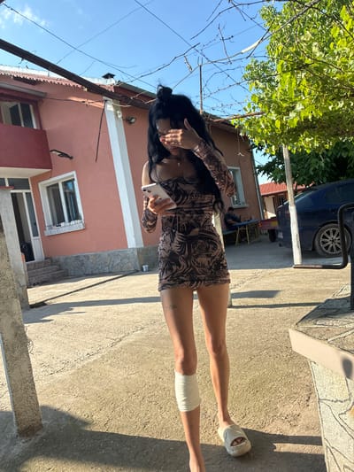A young woman stands outdoors in Radievo, Bulgaria, on a clear, sunny day. She has dark hair styled partially in a bun and wears a short, form-fitting dress with a brown and black pattern resembling body art sleeves. Her right hand covers her face, while her left hand holds a silver smartphone with an illuminated screen. A white bandage is wrapped around her left calf, and she wears a light-colored slide sandal on her right foot, with her left foot bare. Visible tattoos are present on her left thigh.

The ground is concrete or asphalt, exhibiting cracks and debris, strongly illuminated by sunlight, casting distinct shadows. In the mid-ground, a salmon-colored building with white trim around windows and a door is visible, featuring stone cladding at its base. An outdoor light fixture is mounted on this building. In the background, a man in a dark shirt and light shorts sits on a blue bench at a small table, facing the building. A dark blue sedan is parked on the right, with a small utility trailer attached or nearby. Overhead, a bright blue sky is visible through a network of power lines, bare branches, and green foliage from a tree or vine. Concrete posts are present in the foreground and mid-ground.