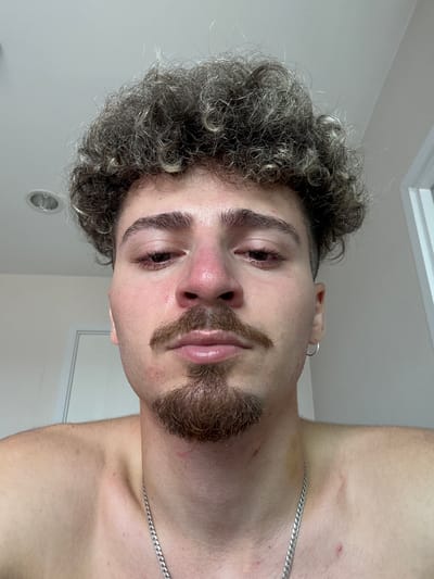 The image shows a close-up, head-and-shoulders shot of a young adult male with curly, light-brown hair and a light brown goatee and mustache. He is looking directly at the camera. His skin appears reddish around his nose and eyes, and there are some red marks on his neck and shoulder area. He is wearing a silver chain necklace. The background is out of focus and appears to be an indoor setting with a white wall and a ceiling light fixture. There is no indication of the location being Sao Thong Hin Town Municipality, Thailand.