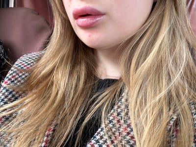The image presents a close-up view of an individual's lower face and upper torso, set in an unspecified indoor location within Dal'nii, Russia. The subject's full, prominent lips, coated with a reflective gloss, are visible. The skin below the lower lip and on the chin exhibits several minor, reddish dermal imperfections. Long, blonde hair, appearing wavy to straight with lighter highlights, frames the face and extends over the shoulders and chest. The visible attire includes a patterned outer garment, displaying a houndstooth or similar check pattern in shades of brown, black, white, and red, worn over a dark, possibly black, knitted inner garment visible at the neckline. The background is indistinct and out of focus, characterized by a blurred, warm, reddish-brown hue. No explicit actions or interactions are depicted.