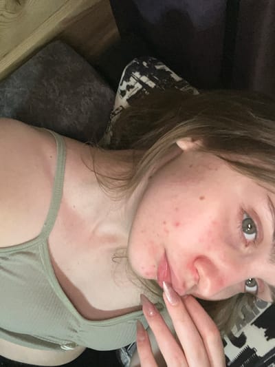 The image shows a close-up, overhead shot of a young woman lying down. She is wearing a light green ribbed tank top. Her face is partially visible, with her right eye and part of her nose and lips in focus. Her skin appears to have some redness and blemishes. Her hand, with long, light brown, glittery nails, is resting near her mouth. The background is dark and out of focus, but suggests an indoor setting with what appears to be wooden furniture and patterned fabric. There is no discernible information within the image that would place the scene in Ashkadar, Russia, or any specific city.