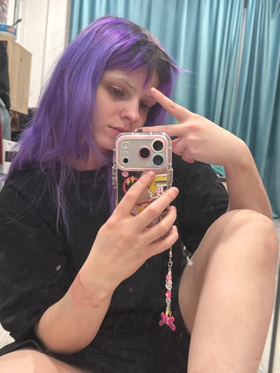 A person with purple hair takes a selfie with a phone in a clear case with stickers. The person is wearing a black shirt. A beaded phone charm with a pink butterfly is attached to the case. The person is making a hand gesture near their forehead. There is a burn or scar visible on the person's arm. The background includes a curtain and furniture.