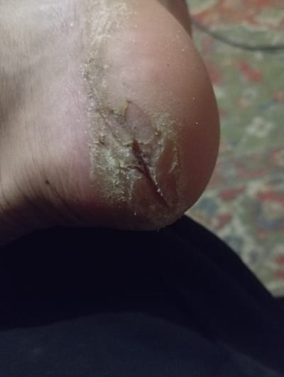 A close-up image focuses on a human heel, exhibiting a deep, horizontal crack across the surface. The skin surrounding the crack appears dry and calloused, with a noticeable build-up of rough, whitish-yellow tissue. The wound reveals a red interior. Dark-colored fabric is visible in the background, partially obscuring the subject. A patterned surface is also seen in the upper-left corner of the frame.
