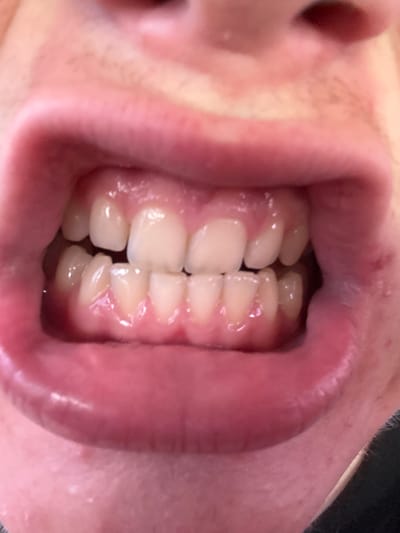 The image shows a close-up of a person's mouth with their teeth visible. The teeth are generally white and appear to be in good condition, though some slight crowding is noticeable in the front incisors. The gums are pink and healthy. The lips are slightly parted, revealing the teeth. The surrounding skin is fair. The image is a detailed, forensic-style close-up of the oral cavity, with no discernible urban or natural environment visible. Therefore, it is impossible to determine any location, including the city of Voronivka, Ukraine, or any environmental context.