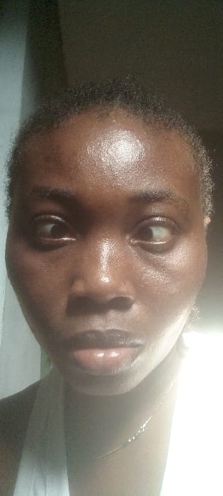 This is a close-up, head-and-shoulders portrait of a dark-skinned individual, identified as a female, located in Agunmo, Nigeria. The subject is centered in the frame, facing forward with a direct but slightly averted gaze. Her dark, short, tightly curled hair is visible along the hairline of her forehead. The skin on her face, particularly the forehead, nose, and cheeks, exhibits a glossy sheen, indicating perspiration or an oily complexion. Her dark brown eyes are visible, with the left eye (viewer's right) showing more sclera on the nasal side and the right eye (viewer's left) showing more sclera on the temporal side, suggesting a slight inward gaze. Her nose is broad, and her lips are full, closed, and appear glossy. A thin, silver-colored chain necklace is present around her neck. The subject is wearing a white garment, visible on the lower right portion of the frame. Lighting originates from the subject's right, casting distinct highlights on the right side of her face and creating subtle shadow on the left. The background is dark and out of focus, providing minimal environmental detail. No discernible actions or interactions are depicted.