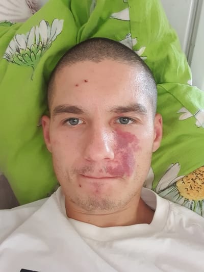 A close-up, angled, portrait-style photograph shows a young man lying down, his head resting on a bright green pillow with a floral pattern. The man has short hair and is wearing a white t-shirt. He has a large, irregular purple birthmark or bruise on the right side of his face, extending from his cheekbone towards his nose and eye. His eye, which is visible, appears to be blue-grey. There are also a couple of small red marks on his forehead. The man's expression is neutral. The setting appears to be indoors, possibly a bedroom, given the pillow and bedding. The lighting is bright and natural, suggesting it could be daytime. The overall mood is somber due to the visible mark on his face. No text is visible in the image.