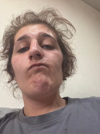 A low-angle close-up shot depicts a person's face and upper chest. The person has light skin, brown hair, and dark eyes. The face is slightly tilted, presenting a view primarily of the nose, mouth, and one cheek, which appears to have some redness or discoloration. The individual wears a gray t-shirt or top. The background is a light, off-white color and appears to be a plain wall. There is no evidence to suggest it was taken in Poleto, Bulgaria.