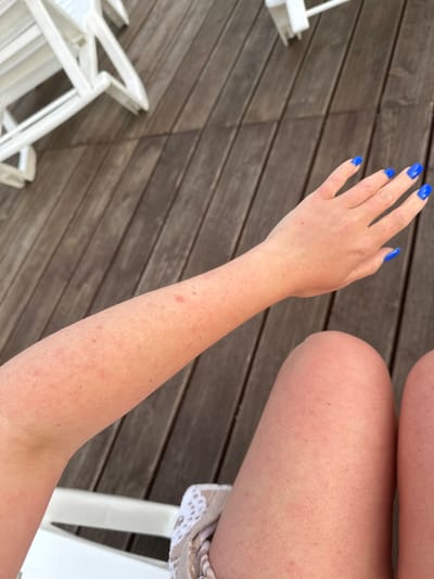 A close-up, overhead shot captures a person's arm and legs against a weathered wooden deck. The individual's skin appears fair with some redness and small bumps, particularly on the arm and thighs. The arm is positioned diagonally across the frame, with the hand at the top right corner, showcasing bright blue nail polish. The legs are visible at the bottom of the image, with the knees in focus. A glimpse of white outdoor furniture and a patterned fabric, possibly a towel, are also visible. The scene is set outdoors on a wooden deck, suggesting a leisure setting. The image does not contain any information about the location being the city of Yuzhnyye Koryaki, Russia.