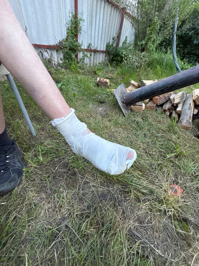 In Mazikino, Russia, a person is seated outdoors with their left leg extended forward. Their lower leg and foot are heavily bandaged with white gauze, suggesting an injury. A black athletic shoe is worn on their left foot. The surrounding environment consists of overgrown grass, with a weathered white fence in the background. To the right of the leg, a pile of chopped wood is visible, with the head of an axe-like tool resting on top of some of the logs. Green foliage and bushes are present behind the fence.