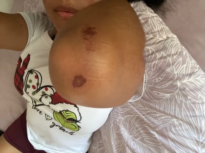 The image shows a close-up view of a person's arm and shoulder, with the arm resting on a bed. The person is wearing a white t-shirt with a graphic of the Grinch on it. There are some bruises visible on the person's arm. The background is a bed with purple and white patterned sheets. The image does not provide any information about the location in the city of Pueblo Salinas, Spain.