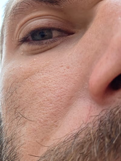 A close-up, low-angle photograph shows a portion of a person's face, focusing on the area around the eye and nose. The subject's skin exhibits visible pores and some small, white bumps, possibly milia. The individual has dark eyebrows and eyelashes. A scattering of facial hairs, likely from a beard, is visible in the lower part of the frame. The background is out of focus, suggesting an outdoor setting with natural light. The specific location within Elmbridge, United Kingdom, cannot be determined from the provided image.