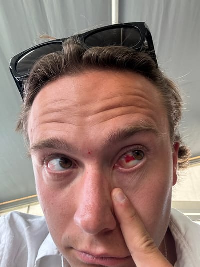 The image shows a close-up of a person's face, focusing on their right eye, which has a significant red blood spot on the sclera. The person is wearing sunglasses on top of their head. A finger is touching the cheekbone near the eye. A small red mark is visible on the person's forehead. The background appears to be an outdoor setting with a light-colored structure. The person is wearing a white shirt. No specific location in Scarperia, Italy can be determined from the image.