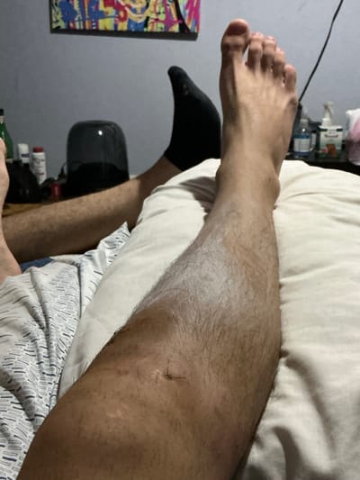 A person's leg rests on a pillow. The leg is hairy and has a small wound with a few stitches near the knee. The person is wearing a black sock on the foot further away. A bed sheet with a patterned design is partially visible. In the background, there's a wall, part of a colorful picture, and some objects on a surface. The lighting is dim.