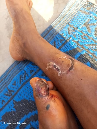 The image shows a close-up of a person's lower leg and foot. The person's skin is dark in color and there are several large wounds on the lower leg and foot. The wounds are red and inflamed, and some are scabbed over. The person is sitting on a blue and black mat. The location is Aramoko, Nigeria, which is a town in Ekiti State, Nigeria. The coordinates provided, 7.791 latitude and 4.502 longitude, are within the town of Aramoko. The image appears to be a photograph taken with a cell phone. The lighting is bright and the focus is clear. The image is likely to be a medical record, showing the severity of the person's injuries. The image is graphic and disturbing.
