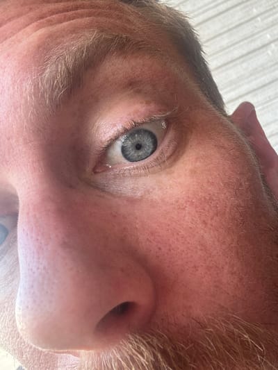 The image captures a close-up of a person's face. A striking gray eye with surrounding lashes is prominently featured, with a visible tear. The skin exhibits details such as pores and facial hair. The person's nose is also in focus. The overall perspective is an extreme close-up shot.