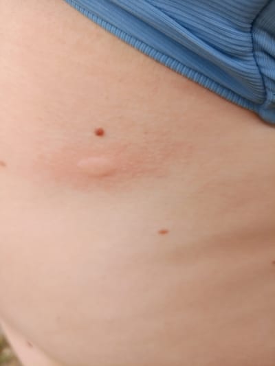 The image shows a close-up view of a person's skin, with a blue ribbed fabric garment visible at the top. The skin is light-toned and appears to have a few moles. A reddish, raised area is visible on the skin, possibly an insect bite or a mild rash. There is also a small, raised, pale bump on the skin. The background is out of focus and appears to be an outdoor environment with some green foliage at the bottom. The image does not contain any specific landmarks or clues that would indicate a location within Pankrushikha, Russia.