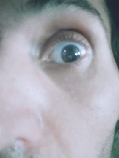 A close-up image focuses on a human eye. The eye is open, with a dark iris and visible white sclera. Skin surrounding the eye is pale and shows fine wrinkles and texture. Some dark hair is visible near the edge of the frame. No information about the city of Remedios de Escalada, Argentina, is present in the image.