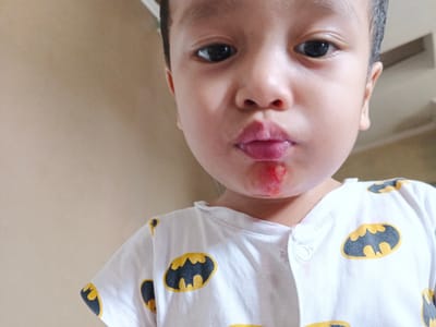 The image shows a close-up, selfie-style shot of a young child, likely a toddler, with a visible injury around their mouth. The child's lips and chin area are red and appear to be scraped or bruised, possibly from a fall or other mishap. The child is wearing a white t-shirt adorned with a pattern of Batman logos in yellow and black. The background is a plain, light brown wall, suggesting an indoor setting. The lighting appears to be natural, possibly from a window, and there are no strong shadows, indicating it's likely daytime. The child's expression is neutral, and the focus is primarily on their face and the injury. There is no visible text in the image. The context provided indicates the location is Cibungbulang, Indonesia.