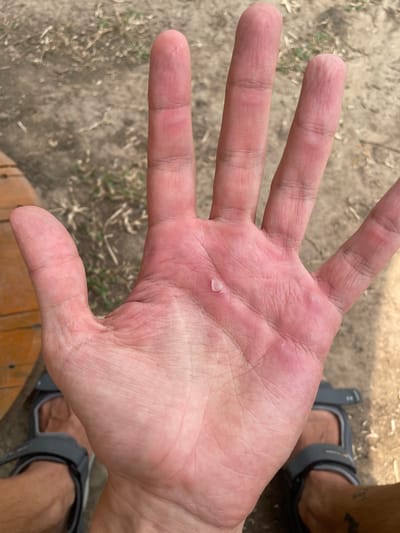 A close-up photograph shows an open human hand, palm up, with a small piece of detached skin lying on the palm's center. The skin fragment is translucent and irregular in shape. The hand is pinkish-red and shows fine lines and creases.
In the background, out of focus, is ground covered with dry vegetation and bare dirt. To the lower right are partial views of a person's legs wearing gray sandals and what appears to be a section of a wooden spool or similar round object.
The image was taken in Tambon Nam Phrae, Thailand, as geotagged.