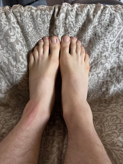A close-up overhead shot shows two bare feet resting on a textured bedspread with a repeating damask pattern in neutral tones. The feet are positioned parallel to each other, with the toes pointing upwards. The skin tone of the feet is fair. The toenails are short and appear clean. The left foot exhibits a reddish discoloration on the ankle and lower shin, suggesting a possible rash or irritation. The right foot appears unblemished. Hairs are visible on the lower legs. The background consists of the intricately patterned fabric. The image was taken in Vancouver, United States of America.