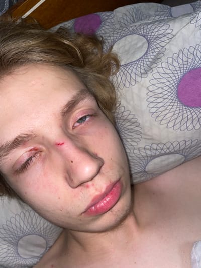 The image shows a close-up, overhead view of a person's face as they lie on a pillow with a patterned design. The person appears to be young and has blond hair. They have visible injuries on their face, including a cut on the bridge of their nose and a laceration near their left eye. There are also several red marks or blemishes on their skin. The background consists of bedding with a purple and white circular pattern and a wooden headboard. The lighting suggests an indoor setting. The image does not contain any information about the city of Pinsk, Belarus.