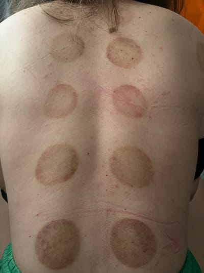 The image shows the upper back of a person with multiple circular marks, consistent with cupping therapy. The marks are reddish-brown to light brown and vary in intensity. They are arranged in two vertical columns on either side of the spine, with four marks in each column. There are also some fainter marks and a few small red dots scattered on the skin. The skin appears fair. The background is not visible, but the person is wearing green shorts at the bottom of the frame. The location in Ożarów Mazowiecki, Poland is not discernible from the image.
