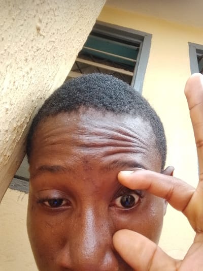 A close-up image, taken at an upward angle, shows the upper face and head of a person of African descent, depicted in Umuokpu, Nigeria. The subject has short, black, tightly-curled hair and dark brown skin, which appears somewhat shiny on the forehead and nose bridge. Prominent horizontal wrinkles are visible across the forehead. The subject's left hand (viewer's right) is positioned with the index finger and thumb actively pulling on the skin around the subject's left eye (viewer's right), causing it to be wide open with a dilated pupil containing a bright reflection. The right eye (viewer's left) is partially closed. A faint vertical line is visible below the left eye. The background on the left consists of a textured, light beige wall or pillar. To the upper right, a lighter yellow wall is visible with two dark-framed windows, one of which shows horizontal teal-colored slats.