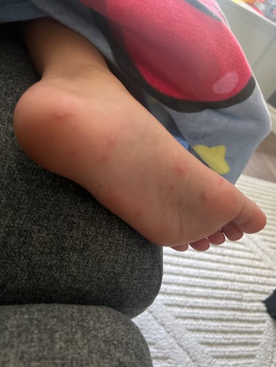 An overhead medium shot shows a child's bare left foot, with the sole facing upwards, resting on a dark grey textured fabric surface. The foot exhibits several small, reddish-pink spots scattered across the sole, primarily towards the arch and heel. The foot is partially covered by a soft, blue blanket featuring a pattern of large pink circular shapes and yellow star-like figures. The background consists of a white, ribbed textured surface. The scene appears to be indoors.