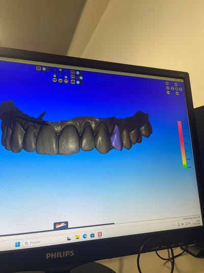 A Philips brand computer monitor is prominently displayed in an indoor setting in Gandra, Portugal. The monitor's screen shows dental computer-aided design (CAD) software with a 3D digital model of a human upper dental arch rendered in dark gray. One specific tooth, positioned on the right side of the arch, is highlighted in light purple. The software interface includes various control icons at the top of the screen: a series of circular and rectangular buttons on the left, and a vertical color gradient scale (red to green, ranging from 0.00 to 0.40) with associated icons on the right. The Windows taskbar is visible at the bottom, displaying "Procurar" (Search) and several application icons, including one labeled "B2". The system tray in the lower right corner indicates "Memory usage: 593.07 MB" and the date "04/03/2026" at "09:39". Dark cables are visible behind the monitor, which is positioned against a plain, light-colored wall.